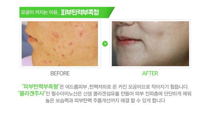 원주 피부과 모공을 작게 피부 탄력 살리다