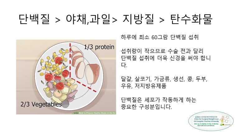고도비만수술의 대세 위소매절제술 후 일반식하기